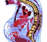 Цветной рентген сечения грудного отдела позвоночника пожилого мужчины с анкилозирующим спондилитом с серьезной дегенерацией нижнего грудного отдела позвоночника . — стоковое фото