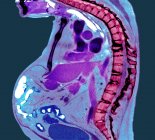 Radiographie colorée de la section à travers la colonne thoracique du patient âgé de sexe masculin atteint de spondylarthrite ankylosante avec dégénérescence sévère de la colonne thoracique inférieure . — Photo de stock