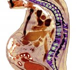 Radiografía coloreada de la sección a través de la columna torácica del paciente varón mayor con espondilitis anquilosante con degeneración severa de la columna torácica inferior . - foto de stock