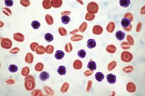 Ilustración digital que muestra células linfoblásticas abundantes en la sangre humana en la leucemia linfoblástica aguda
. - foto de stock