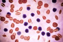 Ilustración digital que muestra células linfoblásticas abundantes en la sangre humana en la leucemia linfoblástica aguda . - foto de stock
