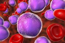Illustration colorée montrant les cellules lymphoblastiques abondantes dans le frottis de moelle osseuse humaine dans la leucémie lymphoblastique aiguë . — Photo de stock