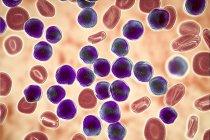 Illustrazione a colori che mostra abbondanti cellule linfoblastiche nello striscio di midollo osseo umano nella leucemia linfoblastica acuta . — Foto stock