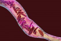 Иллюстрация красных кровяных телец, пораженных серповидноклеточной анемией с клетками полумесяца . — стоковое фото