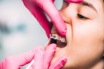Les mains de l'orthodontiste vérifient les appareils dentaires de la fille à la clinique . — Photo de stock