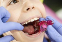 Руки стоматолога накладывают зубные скобки для маленькой девочки . — стоковое фото
