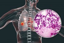 Cancer du poumon, illustration numérique et micrographie photonique montrant un adénocarcinome pulmonaire . — Photo de stock