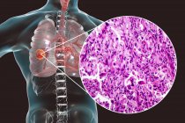 Cáncer de pulmón, ilustración digital y micrografía ligera de tejido canceroso
. - foto de stock