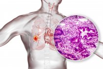 Cancro ai polmoni, illustrazione digitale e micrografo luminoso che mostra adenocarcinoma polmonare
. — Foto stock