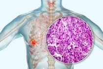 Câncer de pulmão, ilustração digital e micrografia de luz do tecido canceroso . — Fotografia de Stock