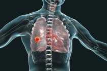 Cancer du poumon, illustration numérique montrant une tumeur maligne du poumon
. — Photo de stock