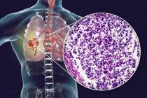 Рак легенів, цифрова ілюстрація, що показує злоякісну пухлина в легенях. — стокове фото