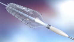 Catéter de stent y balón para implantación en vaso sanguíneo, ilustración digital . - foto de stock