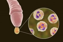 Гонорея инфекции, вызванной бактериями Neisseria гонореи в мужском органе во время уретрита, цифровая иллюстрация . — стоковое фото