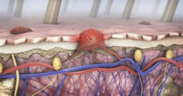 3d иллюстрация поперечного сечения кожи с меланомой в кровотоке и лимфатических путях . — стоковое фото