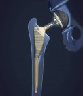Имплантат замены тазобедренного сустава, медицинская цифровая иллюстрация . — стоковое фото