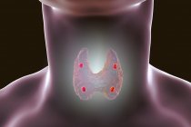 Illustration numérique des glandes parathyroïdes rouges accentuées situées derrière la glande thyroïde en silhouette humaine . — Photo de stock