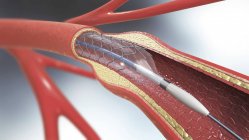Implant d'endoprothèse artérielle, illustration numérique médicale . — Photo de stock