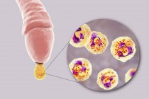 Infección por gonorrea causada por bacterias Neisseria gonorrhoeae en órganos masculinos mientras que uretritis, ilustración digital . - foto de stock