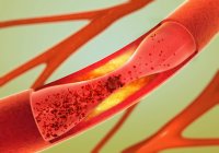 3d цифровая иллюстрация сужения кровеносных сосудов . — стоковое фото