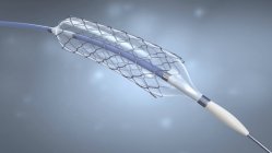 Catéter de stent y balón para implantación en vaso sanguíneo, ilustración digital . - foto de stock
