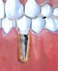 3d иллюстрация зубного импланта в нижней челюсти . — стоковое фото