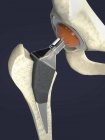 Implants de remplacement de hanche, illustration numérique médicale . — Photo de stock