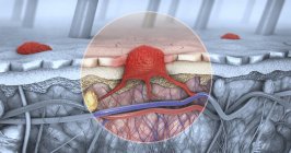 3D-Illustration eines Hautschnitts mit Melanom im Blutkreislauf und Lymphtrakt. — Stockfoto