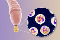Gonorrhoea infection causing by bacteria Neisseria gonorrhoeae in male organ while urethritis, digital illustration. — Stock Photo