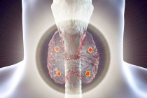Ilustração digital de glândulas paratireoides vermelhas acentuadas situadas atrás da glândula tireoide em silhueta humana
. — Fotografia de Stock