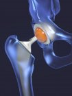 Impianto di sostituzione dell'anca, illustrazione digitale medica . — Foto stock