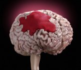 Hirnblutung beim Menschen, digitale Illustration. — Stockfoto