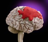 Hémorragie cérébrale humaine, illustration numérique . — Photo de stock