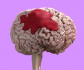 Hemorragia cerebral humana, ilustración digital . - foto de stock