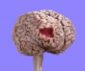 Повреждение мозга человека, цифровая медицинская иллюстрация . — стоковое фото