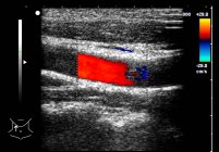 Цветная сонная артерия, медицинское доплеровское ультразвуковое сканирование . — стоковое фото