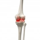 Realistic digital illustration showing arthritis in human knee. — Stock Photo