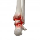 Realistic digital illustration showing arthritis in human ankle. — Stock Photo