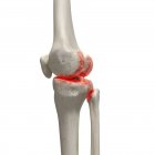 Illustration numérique réaliste montrant l'arthrite dans le genou humain . — Photo de stock