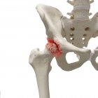 Ilustración digital realista que muestra artritis en la cadera humana . - foto de stock