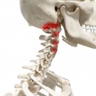 Illustration numérique réaliste montrant l'arthrite dans la colonne cervicale humaine . — Photo de stock