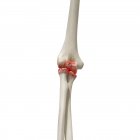 Realistic digital illustration showing arthritis in human elbow. — Stock Photo