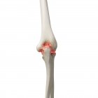 Ilustração digital realista mostrando artrite no cotovelo humano . — Fotografia de Stock