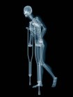 Skeletal system of person on crutches, digital illustration. — Stock Photo