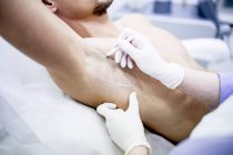 Hautarzt Markierung am Achselarm für Botox-Injektion, Nahaufnahme. — Stockfoto