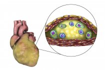 Цифрова ілюстрація хворих жирних серця людини і поперечного перерізу, що крупним планом атеросклеротичних відкладень гістологічної структури, некротичного центру, піноклітин і т-лімфоцитів. — стокове фото