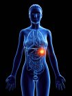 Рак селезінки в жіночому тілі, комп 