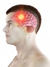 Tumor cerebral en el cuerpo masculino, ilustración conceptual por computadora
. - foto de stock