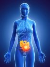 Silueta femenina con cáncer en el intestino delgado, ilustración digital . - foto de stock