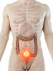 Рак товстої кишки в чоловічому тілі, комп'ютерна ілюстрація. — стокове фото